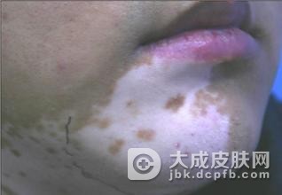 怎么判断白癜风病情转好