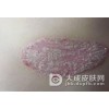 为什么要称银屑病为牛皮癣吗