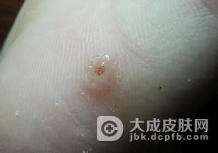 如何更好的预防跖疣