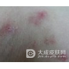 常见湿疹护理的小窍门有哪些呢