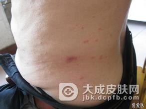 疥疮与其他疾病相鉴别