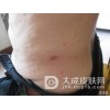 疥疮与其他疾病相鉴别