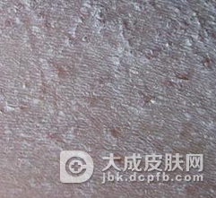 湿疹会不会通过接触而传染呢