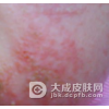 患上湿疹平时要注意什么
