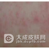 治疗湿疹最快的方法介绍