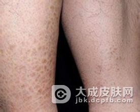 专家为您讲解鱼鳞病日常注意