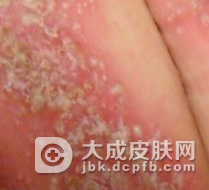 寻常型牛皮癣痒吗