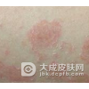 寻常型牛皮癣的症状表现