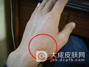 女性下体患荨麻疹该如何护理