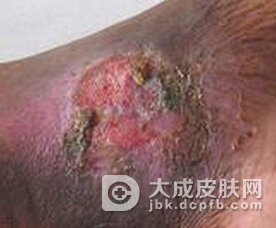 糖尿病足溃疡怎么治疗