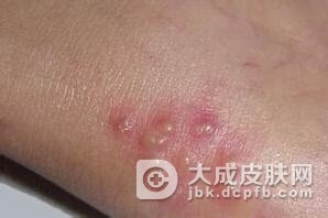 生殖器疱疹55555