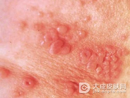 生殖器疱疹的症状有哪些表现