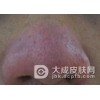 生活中护理酒糟鼻疾病的方法有哪些呢