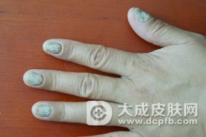扁平苔癣的症状有哪些