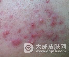 痤疮总不好 试试避孕药