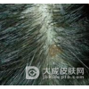 白头癣怎么引起的