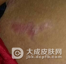 股癣会不会传染 2个传播途径一定要了解