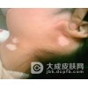 白癜风的早期症状有什么