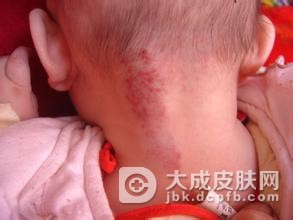 儿童血管瘤的发病原因？