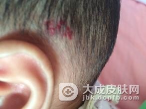 血管瘤是怎么产生的你了解吗