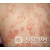 红皮型银屑病护理方法