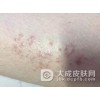 预防传染性软疣的小方法