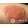 男性得尖锐湿疣的病因是啥