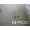 传染性软疣在治疗过程中有什么辅助方法