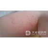 过敏体质患者怎么预防皮肤过敏
