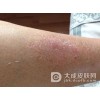 银屑病患者洗澡要注意什么