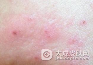 慢性湿疹为什么治愈后容易发作