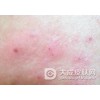 慢性湿疹为什么治愈后容易发作