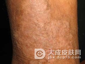 预防慢性湿疹要注意外界发物的影响