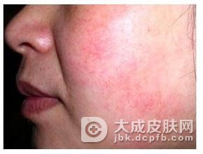 红血丝形成的原因