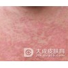 慢性湿疹的出现跟什么原因有关