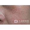 红血丝的病因有哪些
