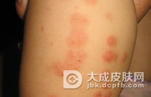 怎么样判断疥疮是不是又复发了呢