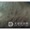 阴囊上长红疙瘩当心是疥疮