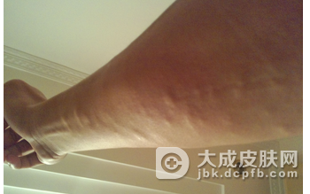 解析脂肪瘤应该怎样预防？