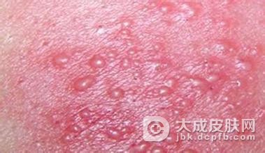 怎样进行生殖器疱疹疾病的护理呢