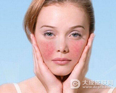 秋季脸部红血丝怎么办 敏感肌肤护理方法
