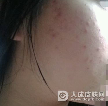 成人面部湿疹怎么办 治愈面子问题不可忽视