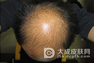 脂溢性脱发和斑秃的鉴别比较