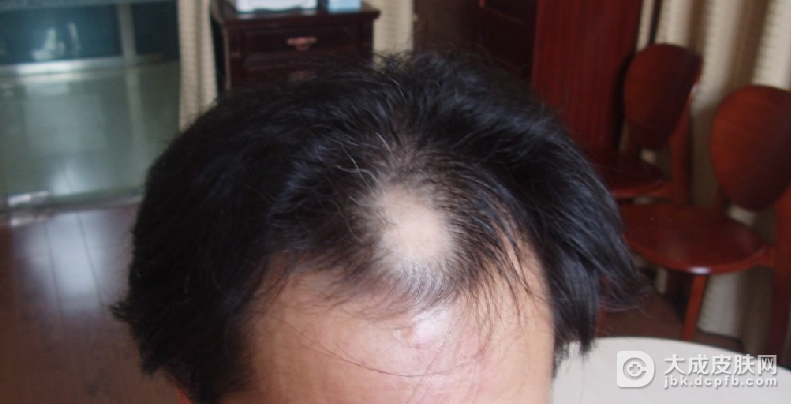 脂溢性脱发到底是一种什么病