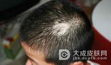 治疗脂溢性脱发有妙招