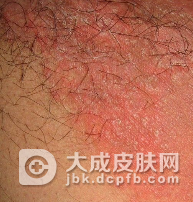 股癣有哪些治疗误区
