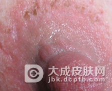 乳房湿疹要怎么诊断呢
