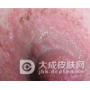 乳房湿疹要怎么诊断呢