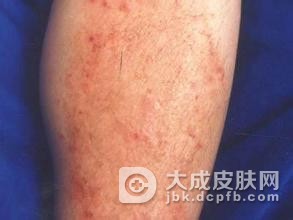 过敏性皮炎日常护理方法有哪些呢