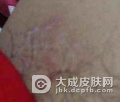 股癣有哪些发病症状